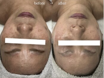 サロン レナ(Salon Re:na)/Revi ハーブピーリング