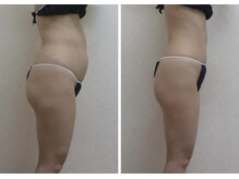 ビューティースパ/施術・ビフォーアフター 