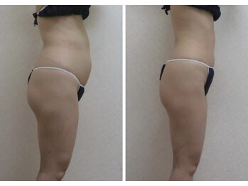 ビューティースパ/施術・ビフォーアフター 