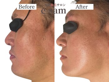 イーサム 高槻摂津富田店(e-sam)/髭脱毛