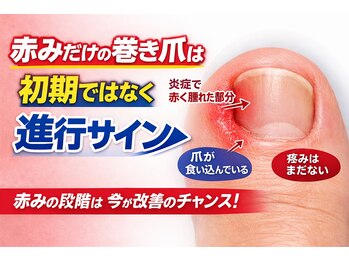 巻き爪じゅん 千葉駅前店/赤みだけの巻き爪は危険サイン？