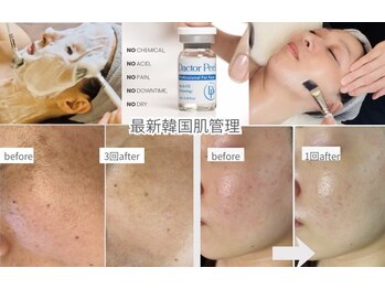 ビオラ(美ola)の写真/【春のゆらぎ肌/花粉対策】韓国肌管理ダクトピールで水光ツヤ肌へ♪