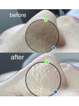 サロン ド ソワン(salon de soin)/毛穴エクストラクション