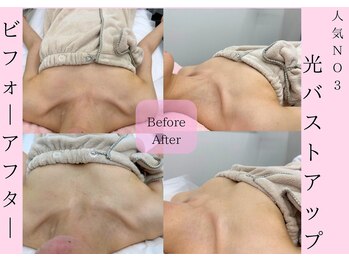 Cスキンケアクリニック 麻布店/光バストケアBeforeAfter