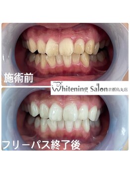 ホワイトニングサロン 京都烏丸店/ホワイトニング施術例