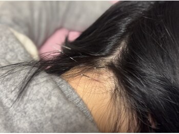 ぽぽらす鍼灸院 接骨院/施術風景(鍼灸)