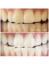 ホワイトニングルーム 川崎店(WhiteningRoom)/ホワイトニング/川崎　