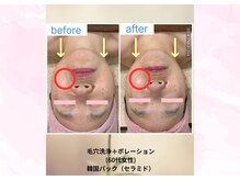 クローバー(clover)/毛穴洗浄＋ポレーション