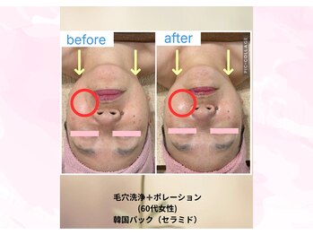 クローバー(clover)/毛穴洗浄+ポレーション