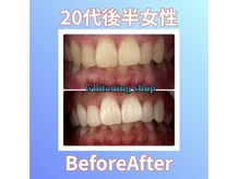 ホワイトニングショップ 西原店/20代後半女性☆BeforeAfter