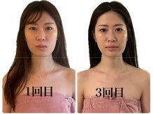 カムズ ビューティー(COMES BEAUTY)/小顔スッキリ劇的変化！