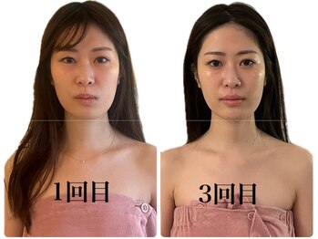 カムズ ビューティー(COMES BEAUTY)/小顔スッキリ劇的変化！