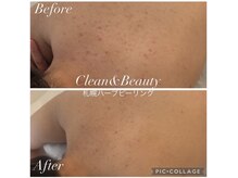 クリーンアンドビューティ 札幌(Clean&Beauty)/夏前に背中のハーブピーリング♪