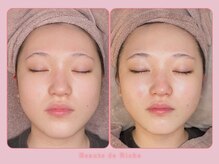 ボーテドリッシュ(Beaute de Riche)/美白フェイシャルbeforeafter