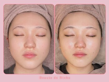 ボーテドリッシュ(Beaute de Riche)/美白フェイシャルbeforeafter