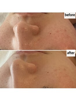 メナードフェイシャルサロン 岐阜茜部/紫外線ケア/シミケア/美白