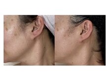 アフロディーテ(Aphrodite)/シミケアとフェイスラインUP