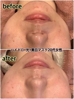 リソル(RISOL)/ニキビケアにも◎ハイドロ＋光