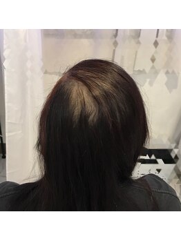 アブソリュートワン(absolute1)/頭髪育毛促進☆エクソソーム