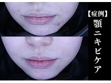 The水光美肌専科/ニキビケアの症例 豊富