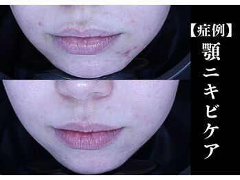 The水光美肌専科/ニキビケアの症例 豊富