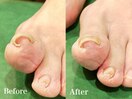 巻き爪矯正ビフォーアフター