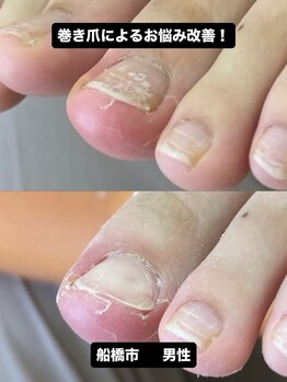 巻き爪じゅん 船橋店/巻き爪の痛みが改善して笑顔に！