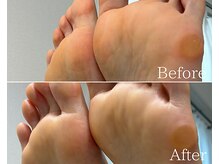 カシェット 広島店(Cachette)/30代女性☆足裏角質ケア90分