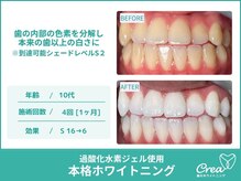 クレア(Crea)/【ホワイトニング症例写真】