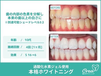 クレア(Crea)/【ホワイトニング症例写真】