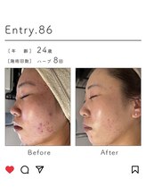 ビューティリュクス(beauty luxe)/超肌質改善ハーブピーリング