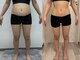 パールプラス 都城店の写真/本格痩身で脂肪を燃焼&分解！気になる箇所を集中ケア！脂肪燃焼&分解で理想の美BODYへと導きます♪