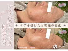 ルプレ(Lupure)の雰囲気（ハーブピーリング３回の施術で肌質改善◎低刺激なのに効果絶大◎）