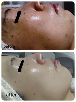 レゾン 京橋店/【ビフォーアフター】ニキビケア