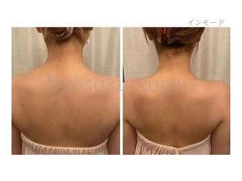 メディカルエステ 新宿南口店/*インモード肩症例写真*