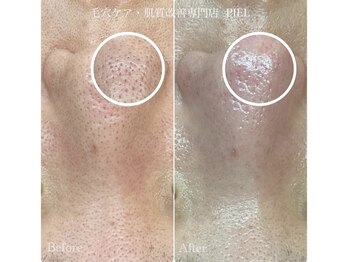 ピエル 北千住店(PIEL)/セットメニューで更に綺麗に