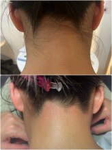 スパークル/ブライダル/ワックス脱毛/脱毛