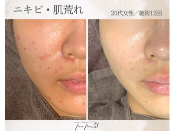 スリースリー(THREE THREE)/ニキビ・肌荒れ