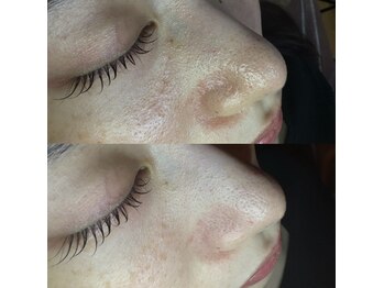 ルピナス 立川店/毛穴洗浄