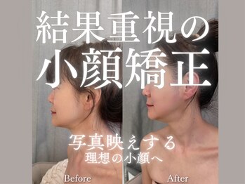 ラシーク(LASEEQ)/世界一の小顔術