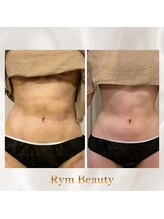 リム ビューティー(RYM BEAUTY)/インディバ ボディ術後