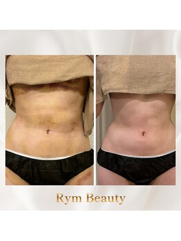 リム ビューティー(RYM BEAUTY)/インディバ ボディ術後