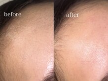 アウル 北千住本店(auL)/【フェイスワックス】額