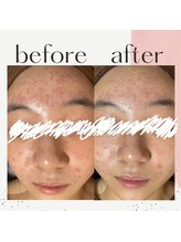 ミルル(milulu)/思春期ケアもお任せください！