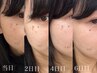 【本気の肌改善ピーリング】素肌を綺麗にしたい方に♪