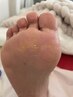 【タコ・ウオノメ特化メニュー】¥15000→