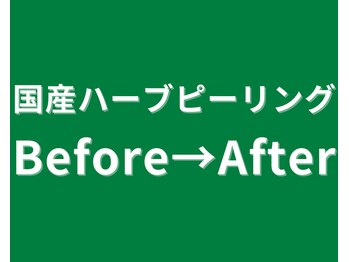 イーラボ 池袋店(e-LABO)/大人気!国産ハーブピーリング