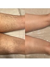 ハナサクラ 心斎橋(HANASAKURA)/メンズワックス脱毛