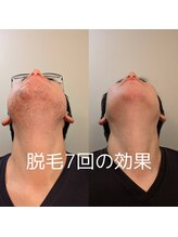 バロン/髭脱毛効果1