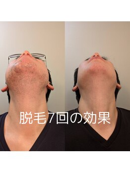 バロン/髭脱毛効果1